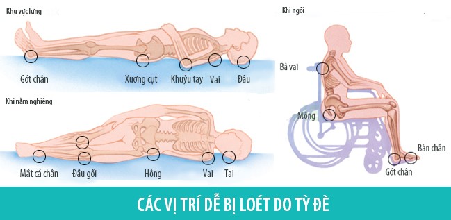 Các vị trí dễ bị loét tì đè